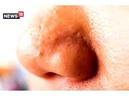 From Honey To Sandalwood, Natural Ways To Get Rid Of Oily Nose