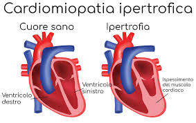 Segni e sintomi clinici della fase acuta possono essere rappresentati da febbre, abbattimento ed aritmie cardiache con possibile. Cardiomiopatia Ipertrofica Cause Sintomi Pericoli E Cura