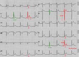 Myocarditis (mk) is a cardiovascular disease characterized by heart muscle damage due to the development of inflammation in the tissues of the the most frequent ecg signs of myocarditis Myocarditis Amboss