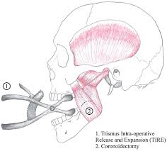 Image result for Trismus