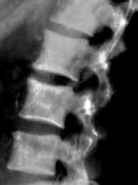  1  breast, colorectal, lung, kidney, head and neck, and uterus cancers are the most common primary tumors with lung metastasis at autopsy. Pathology Outlines Metastases