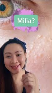 Professional Milia Treatment: The Best Options for Fast Results