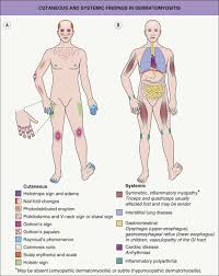 Image result for Dermatomyositis