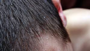 With every problem, there's a solution! Dermatologists Tips To Treat And Control Dandruff Medical Bag
