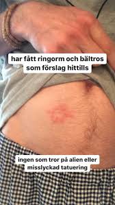 Måste bokas 24 h innan annars tillkommer extrakostnad. Jonathan Tengwall Sur Twitter Ni Kanske Ocksa Kan Hjalpa Mig Nojer Mig Saklart Inte Med Rovbold Utan Har Tydligen Baltros Och Eller Ringorm Nu Ping Alla Som Vet Saker Https T Co Ukro4ojptw