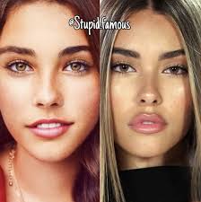 How to become a lip injector. Madison Beer In 2021 Lip Fillers Celebrity Lip Fillers Celebrity Plastic Surgery