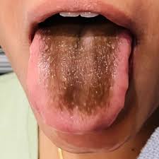 Image result for brown tongue symptoms
