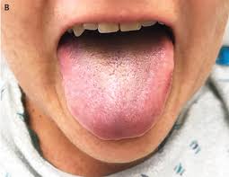 Image result for black hairy tongue symptoms
