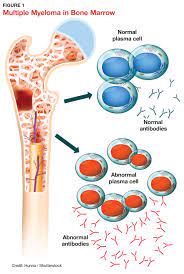 Multiple myeloma is a form of cancer that occurs due to abnormal and uncontrolled growth of plasma cells in some people with multiple myeloma, especially those with early stages of the condition. Diagnosing Multiple Myeloma In Primary Care Clinician Reviews