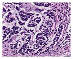 Oct 01, 2020 · basal cell carcinoma of skin of nose. Histological Immunohistological And Clinical Features Of Merkel Cell Carcinoma In Correlation To Merkel Cell Polyomavirus Status