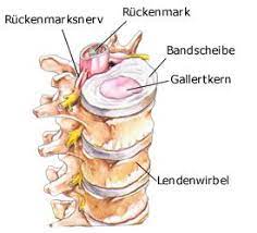 Gallertkern — eine bandscheibe (lat. Bandscheiben Gesundheit De