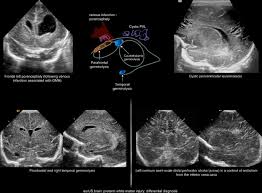 Jul 15, 2021 · the filipino's global newspaper. Preterm White Matter Injury Ultrasound Diagnosis And Classification Pediatric Research