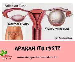Bagaimana cara mengatasi pilonidal cyst? Kenali Penyakit Cyst Shidarahmat