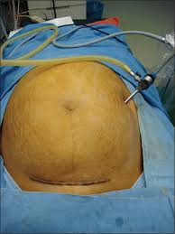 Most bowel injuries happen because of adhesions to the abdominal wall near the base of the umbilicus. Jain Point A New Safe Portal For Laparoscopic Entry In Previous Surgery Cases Abstract Europe Pmc