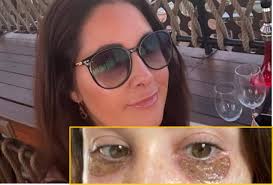 눈밑 타들어 가, 출산보다 아팠다"...'이 시술' 받고 평생 흉터, 배상금 1700만원?