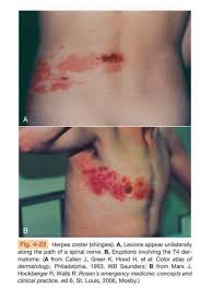 Image result for Varicella zoster on human skin