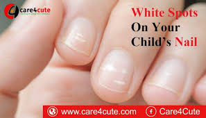 White Spots On Your Child S Nail Should You Be Worried