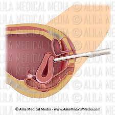 Alila Medical Media Utero Retrovertido Com Sonda De Ultra Som Ilustracao Medica