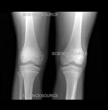 Image result for Knee XRay