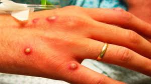 Where monkeypox originates is unknown, but it is thought to be spread by small rodents and squirrels in the rain forests of africa, mostly in western and central africa. Monkeypox Infection How To Avoid Monkey Pox Disease Fans Lite