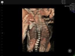 Image result for First Trimester Ultrasound