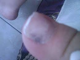 Taches blanches à cause d'un manque de calcium. Ongle De Pied Avec Une Tache Marron Les Soins Des Ongles Et Des Mains