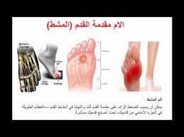 تشخيص و علاج ألم مشط القدم Youtube