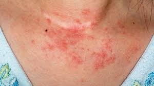 Check spelling or type a new query. Eczema In Pictures Everyday Health