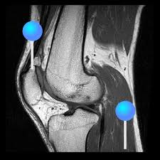 This imaging technique is used to diagnose and evaluate edema, partial or complete muscle tears, and hematoma. The Knee Mri Atlas Of Anatomy In Medical Imagery