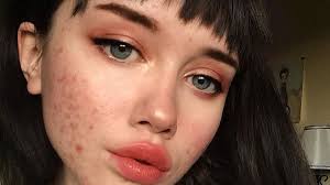 Image result for acne face