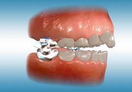 Check spelling or type a new query. Orthodontic Appliances Texas Orthodontic Specialists