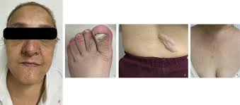 Cutaneous manifestations of TSC: (a) facial angiofibromas: multiple...