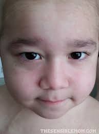 David's Story: Bone Marrow Transplant (Day +16 through Day +18) for Severe  Aplastic Anemia