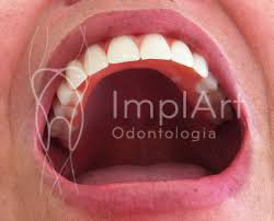 Protese Fixa Implante Implantes Dentarios E Estetica Dental