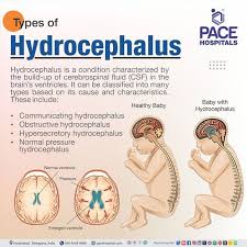 Image result for Hydrocephalus