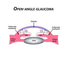Why Myopia Increases the Relative Risk of Open-angle Glaucoma - Review of  Myopia Management