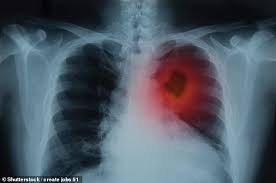 The following diagnostics are recommended: Pioneering Lung Cancer Treatment Uses Hot Needle To Zap Tumours In Just 30 Minutes Daily Mail Online