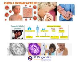 Image result for Rubella