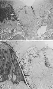 Recessed lights work for ambient, task and accent lighting. Mechanisms Of Resorption And Remodeling Of Cartilage Sciencedirect