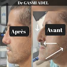 Dr.GASMI ADEL chirurgie maxillo-faciale د.قاسمي عادل