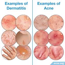 Image result for contact dermatitis