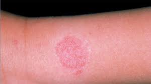 What Does Contact Dermatitis Look Like On A Baby Parents
