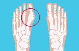 Merendam kaki merendam kaki dapat mengurangi peradangan pada sendi jempol kaki. Bunion Penyebab Gejala Dan Penanganan Idn Medis