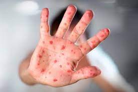 Karena disebabkan oleh virus, flu singapura termasuk penyakit yang menular. Gejala Flu Singapura Penyakit Tangan Kaki Dan Mulut Akibat Virus