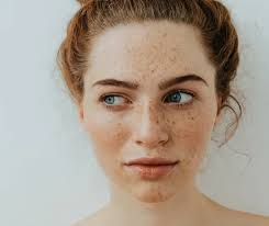 Freckles and Facial Pigmentation Removal