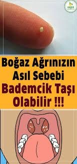 Bogaz Agrinizin Asil Sebebi Bademcik Tasi Olabilir Bogaz Agri Bademcik Tedavi Neiyigelir Ne Iyi Gelir Knowledge