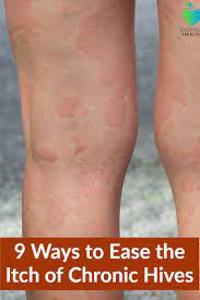 9 Ways To Ease The Itch Of Chronic Hives Everyday Health Chronic Hives Hives Treatment Itch Relief Skin