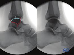 Image result for Ankle XRay