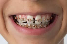 Then, swish the rinse inside your mouth for about 30 seconds at a. Common Issues With Braces At Home Fixes Salaita Orthodontics