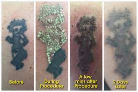 Get phone numbers, addresses, maps & driving directions on goldenpages.ie search. Laser Tattoo Removal The House Of Nails